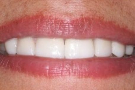 before and after pictures