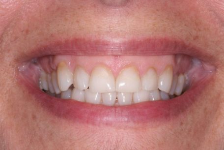 before and after pictures