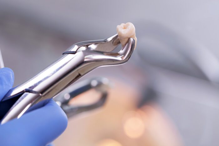 How to Have a Successful Tooth Extraction