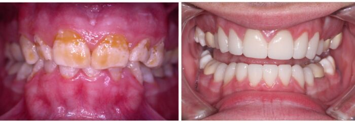 Dental patient before and after porcelain veneers in Silver Spring