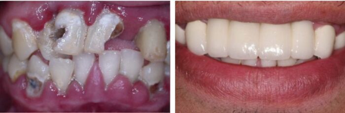 Dental patient before and after dental bridge from Dr. David Rever