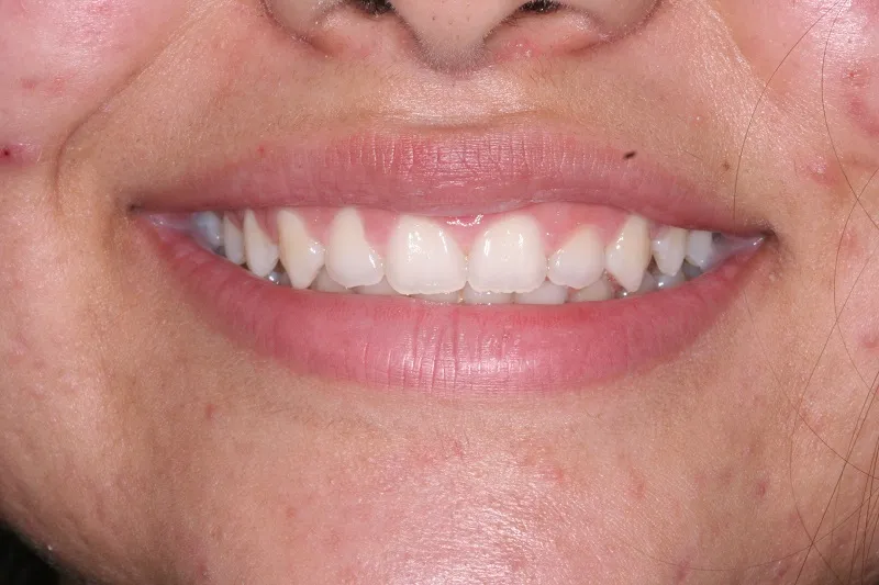 After photo