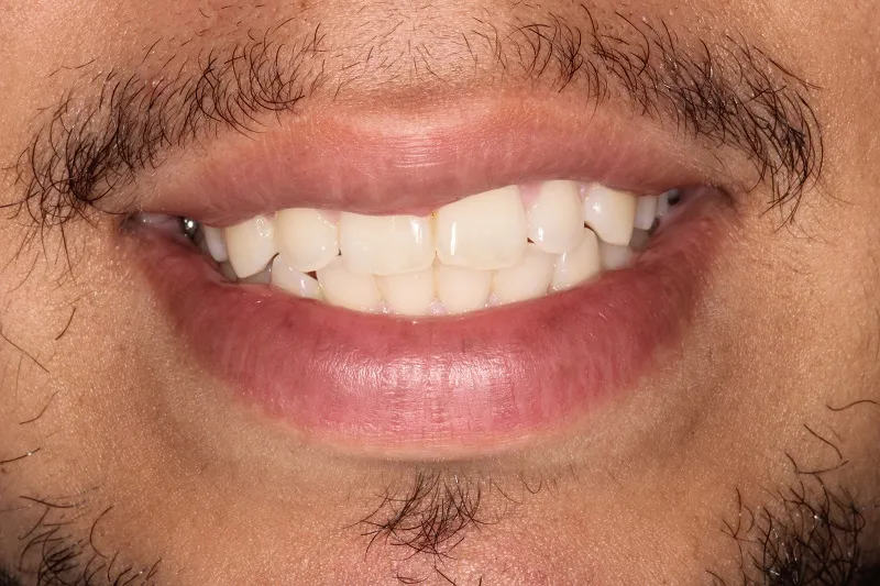 After photo