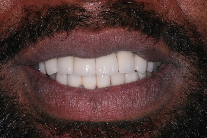 After photo